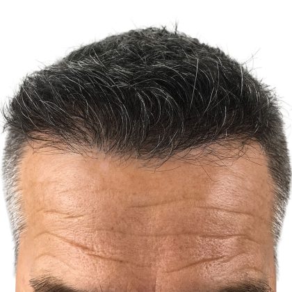 Hair Transplants Before & After Patient #3611