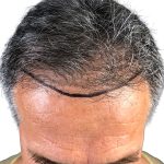 Hair Transplants Before & After Patient #3611