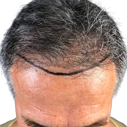 Hair Transplants Before & After Patient #3611