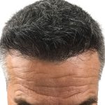 Hair Transplants Before & After Patient #3611