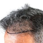 Hair Transplants Before & After Patient #3611