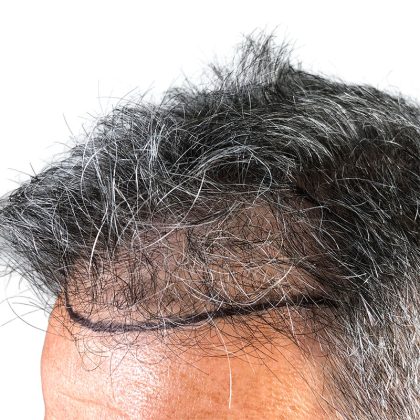 Hair Transplants Before & After Patient #3611