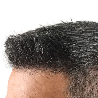 Hair Transplants Before & After Patient #3611