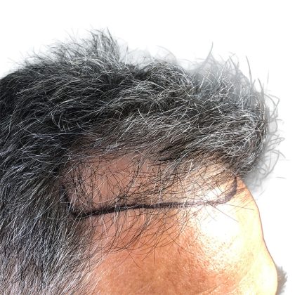 Hair Transplants Before & After Patient #3611