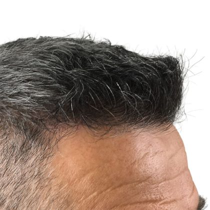 Hair Transplants Before & After Patient #3611