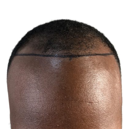 Hair Transplants Before & After Patient #3648