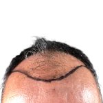 Hair Transplants Before & After Patient #3650