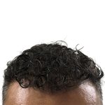Hair Transplants Before & After Patient #3650