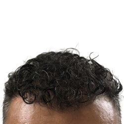 Hair Transplants Before & After Patient #3650