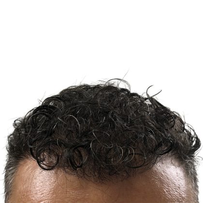 Hair Transplants Before & After Patient #3650