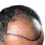 Hair Transplants Before & After Patient #3650