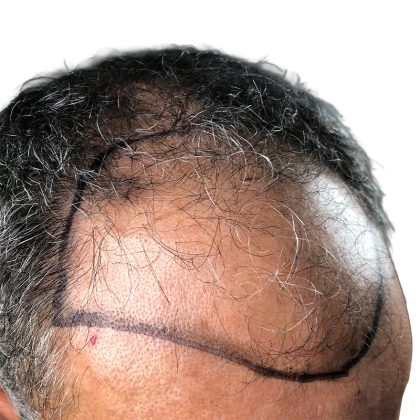 Hair Transplants Before & After Patient #3650