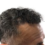 Hair Transplants Before & After Patient #3650