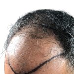 Hair Transplants Before & After Patient #3650