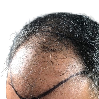Hair Transplants Before & After Patient #3650
