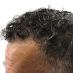 Hair Transplants Before & After Patient #3650
