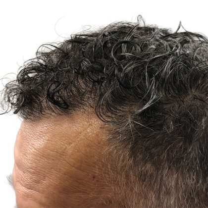 Hair Transplants Before & After Patient #3650