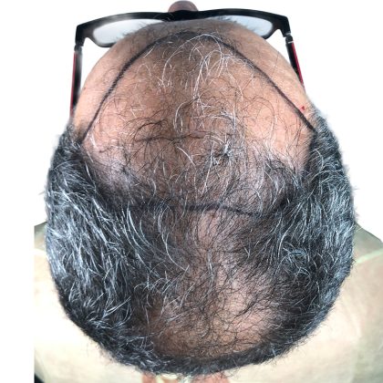 Hair Transplants Before & After Patient #3650