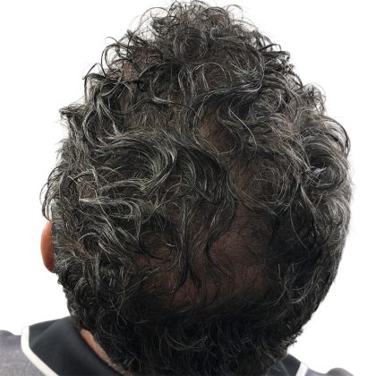 Hair Transplants Before & After Patient #3650