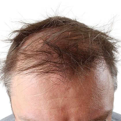 Hair Transplants Before & After Patient #3651