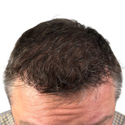 Hair Transplants Before & After Patient #3651