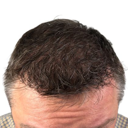 Hair Transplants Before & After Patient #3651