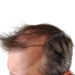Hair Transplants Before & After Patient #3651