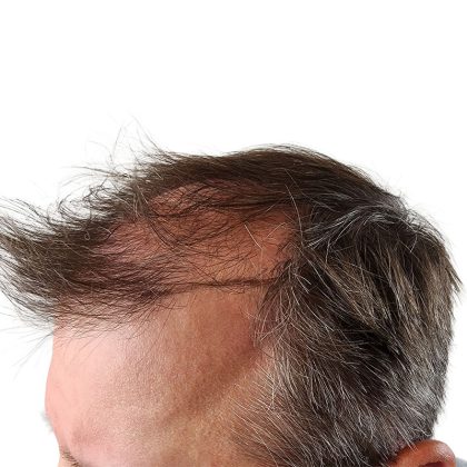 Hair Transplants Before & After Patient #3651