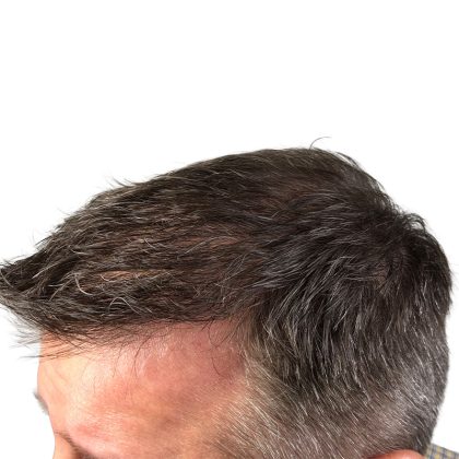 Hair Transplants Before & After Patient #3651