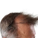Hair Transplants Before & After Patient #3651