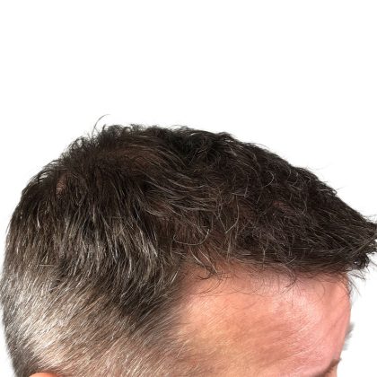 Hair Transplants Before & After Patient #3651