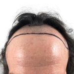 Hair Transplants Before & After Patient #3652