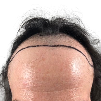 Hair Transplants Before & After Patient #3652