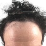 Hair Transplants Before & After Patient #3652