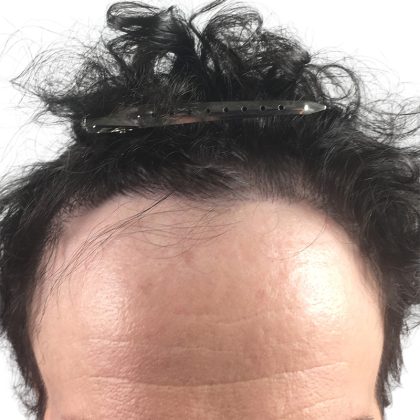 Hair Transplants Before & After Patient #3652