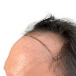 Hair Transplants Before & After Patient #3652