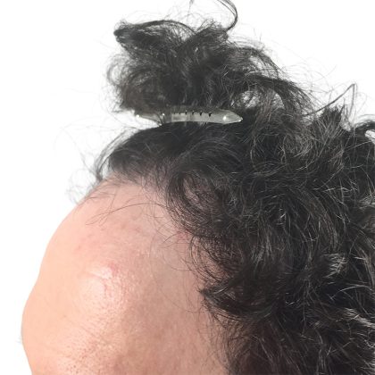 Hair Transplants Before & After Patient #3652
