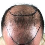 Hair Transplants Before & After Patient #3653