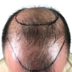 Hair Transplants Before & After Patient #3653