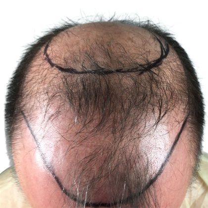Hair Transplants Before & After Patient #3653