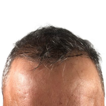 Hair Transplants Before & After Patient #3654
