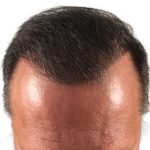 Hair Transplants Before & After Patient #3653