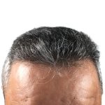 Hair Transplants Before & After Patient #3654