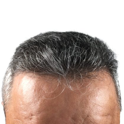 Hair Transplants Before & After Patient #3654