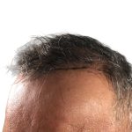 Hair Transplants Before & After Patient #3654