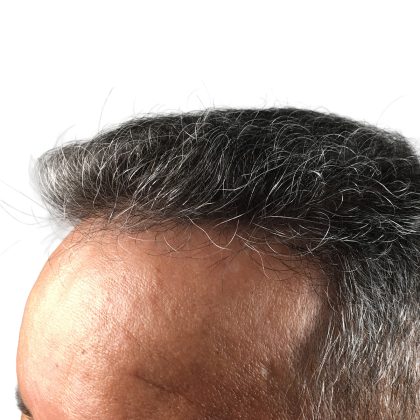 Hair Transplants Before & After Patient #3654