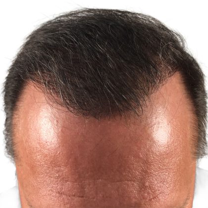 Hair Transplants Before & After Patient #3653