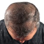 Hair Transplants Before & After Patient #3654