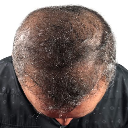 Hair Transplants Before & After Patient #3654