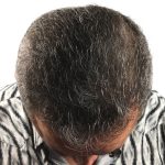 Hair Transplants Before & After Patient #3654
